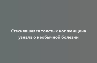 Стеснявшаяся толстых ног женщина узнала о необычной болезни