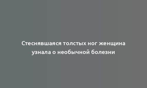 Стеснявшаяся толстых ног женщина узнала о необычной болезни